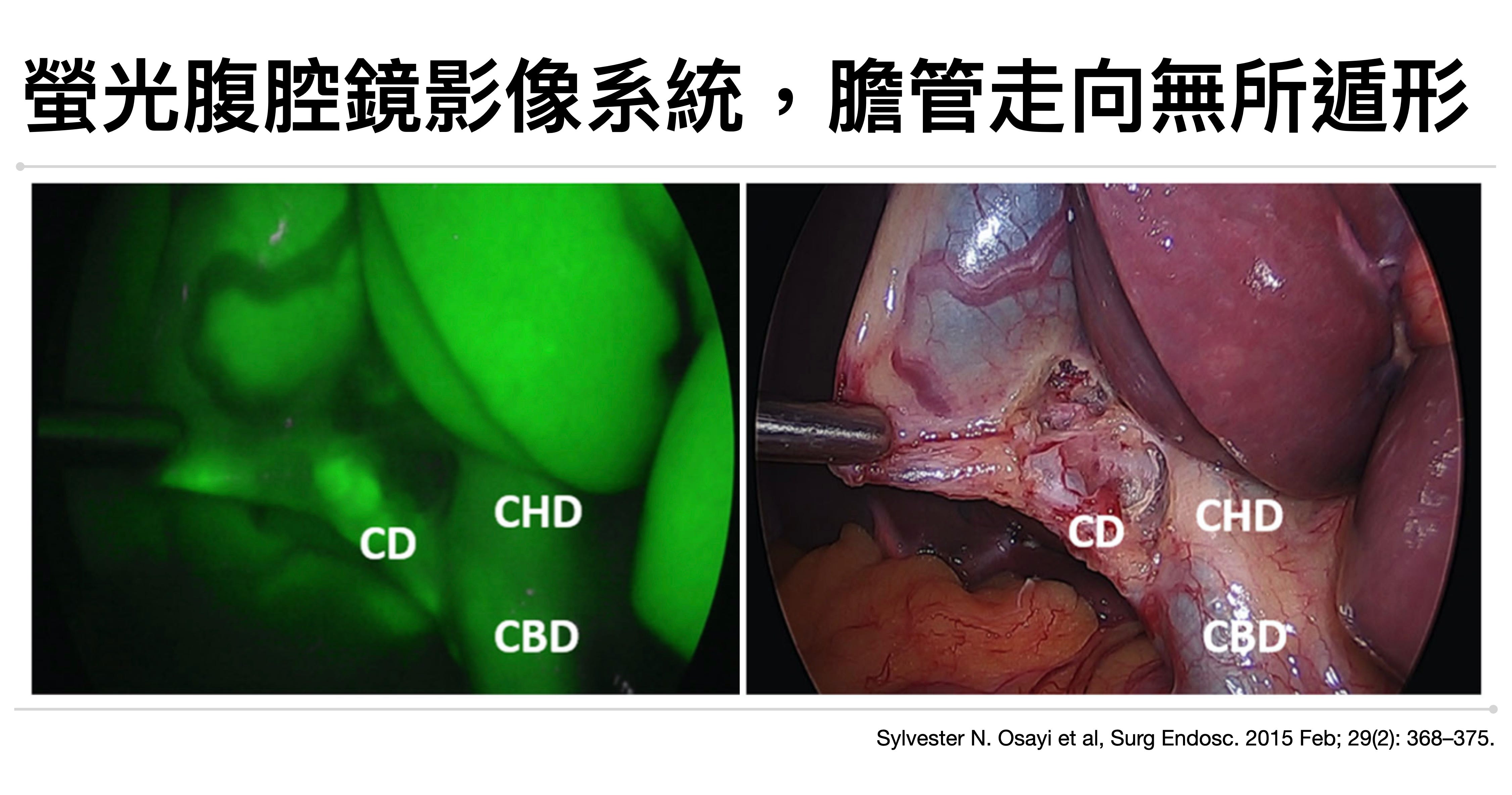 螢光腹腔鏡(ICG)影像