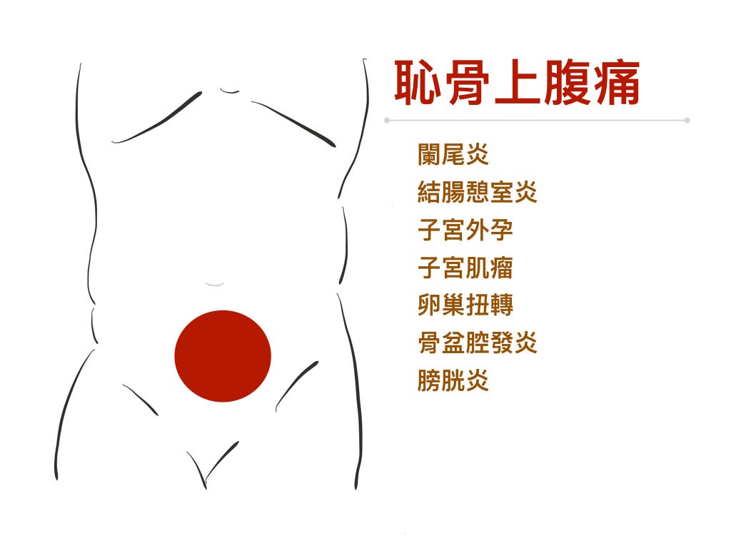 恥骨上腹痛