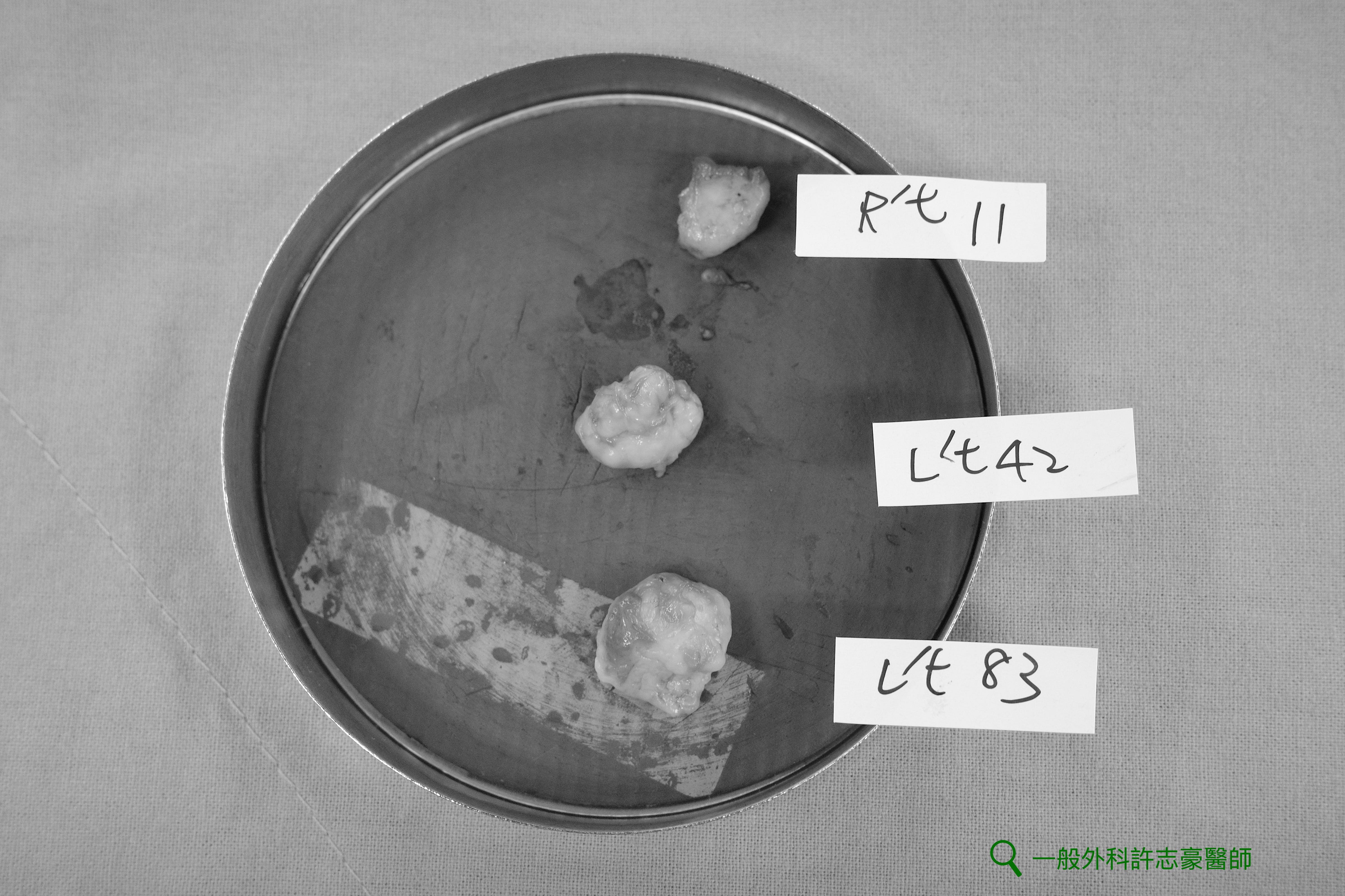乳房腫瘤切除術取得之完整檢體