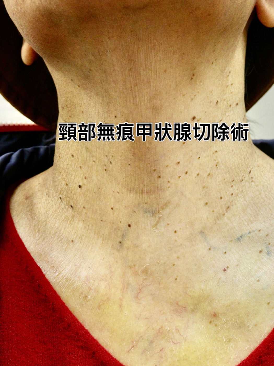 頸部無痕甲狀腺切除術示意影像